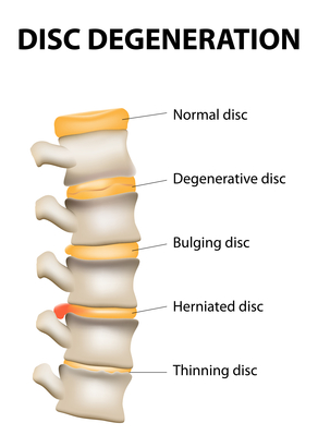 Herniated Discs and Disc degeneration